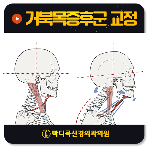 거북목증후군 셀프 교정, 효과 없는 이유는 무엇일까요?