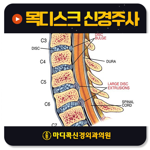 목디스크 신경주사 효과, 왜 사람마다 다를까?